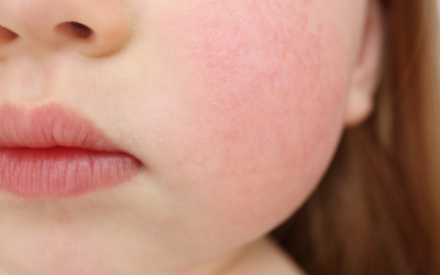 Food allergy research in South Africa: What proportion of children with egg and peanut allergies outgrow their allergies after 5 years?